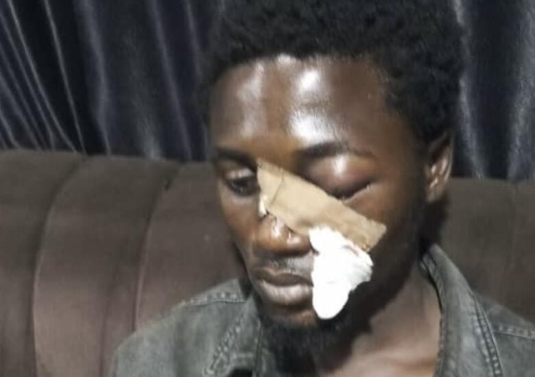 Nigerian Man Loses Eye After Police Fire Teargas At Close Range In Abuja, Another Shot In Katsina